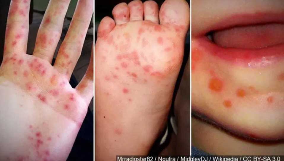 Infant with Hand Foot and Mouth Disease 